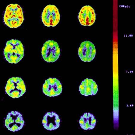 Alterazioni del Metabolismo Cerebrale del Glucosio nelle Malattie Neurodegenerative: la Demenza di Alzheimer Progressivo e globale decadimento delle funzioni cognitive
