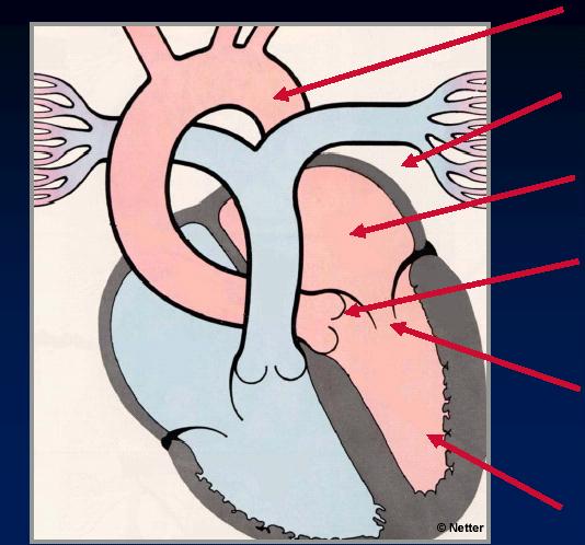 Altre cardiopatie congenite che si presentano con shock/scompenso dotto dipendenza sistemica Tempo di presentazione della cardiopatia: primi giorni o settimane di vita Coartazione aortica Cor