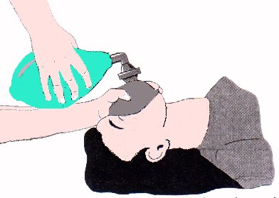 La ventilazione artificiale la tecnica - Posizionarsi alla testa della vittima Posizionare la maschera coprendo bocca e naso (maschera della misura giusta) Tecnica della mano a C per far aderire bene