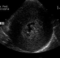 Substrato Trigger BESV BEV PM Manipolaz cateteri Volume Δ