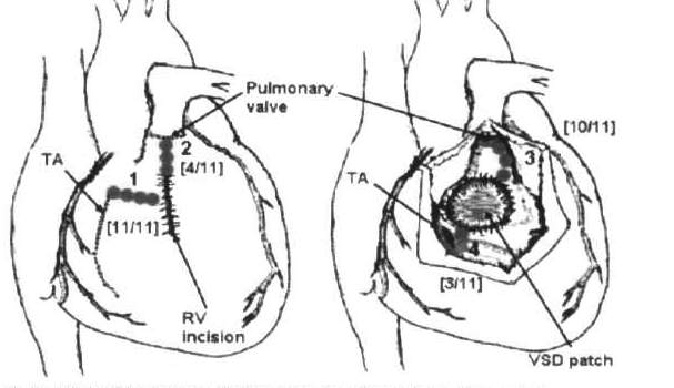 Tetralogia di Fallot