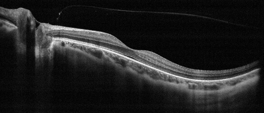 6 mm scan solo macula 12 mm scan