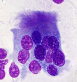Le cellule normali presentano: - forma e dimensione regolari ed uniformi - nuclei normocromici, di forma e di volume regolari - cromatina finemente