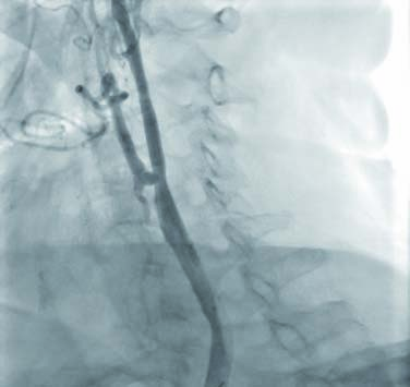 5a: Angiografia di arco aortico Tipo III in paziente suscettibile di angioplastica carotidea sinistra. Fig.