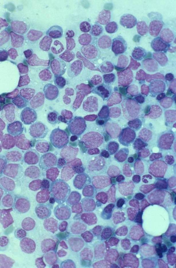 Morphology of lymphs BM