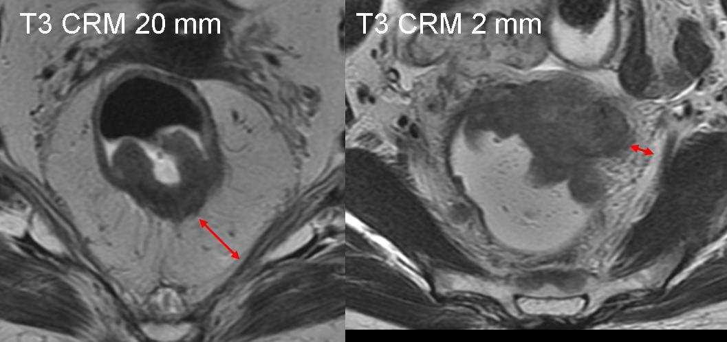 Margine di resezione circonferenziale Prognosi differente se