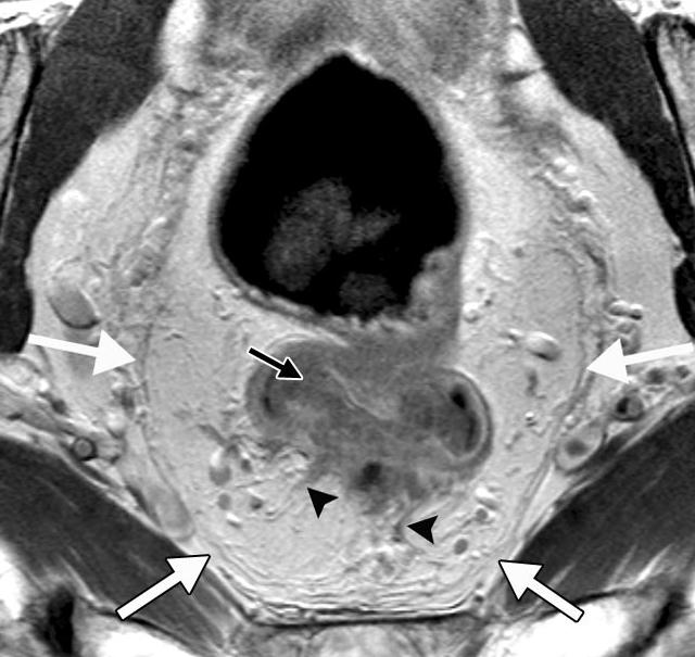 Margine di resezione circonferenziale RM Tumore rettale (freccia nera) con sepimenti transmurali (triangoli) a livello del grasso