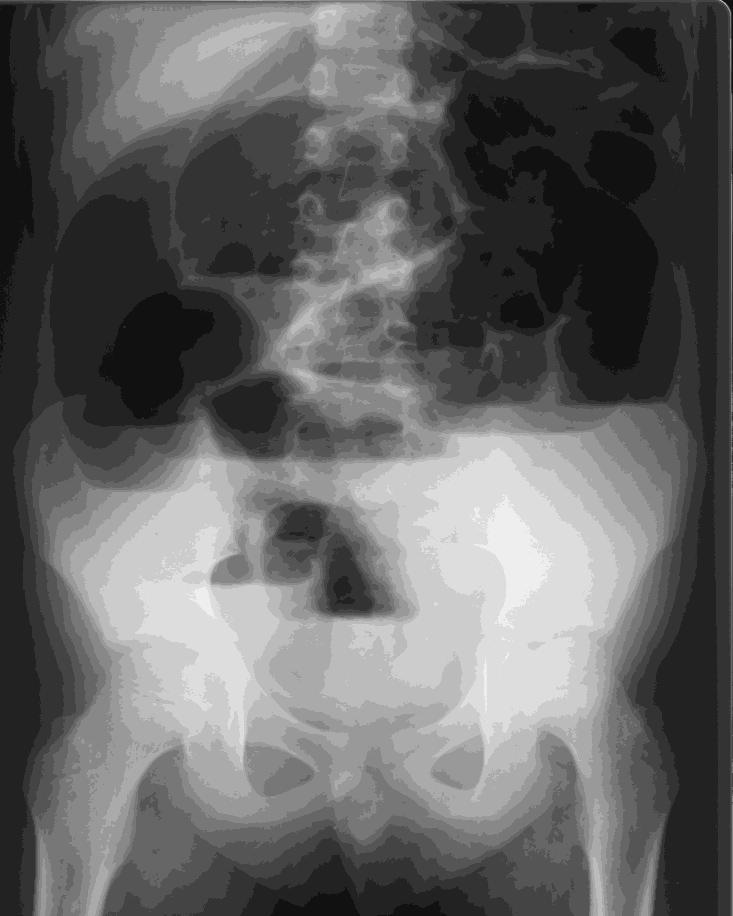 Radiografia convenzionale Identificare livelli