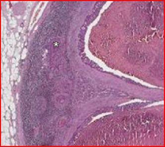 Adenocarcinoma Immagine RM: Tumore rettale (freccia) e due linfonodi interessati dal