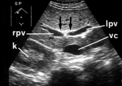 Vie Biliari Intraepatiche Normale: Dotto Epatico dx e sin