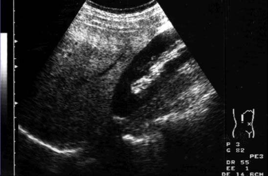 Coarse Echo Pattern