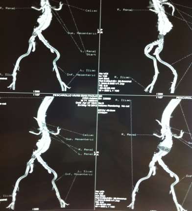 Planning preoperatorio angiotc pre TC per definizione