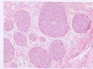 Il tumore Benigno: adenoma QuickTime e un decompressore TIFF (LZW) sono necessari per visualizzare quest'immagine.