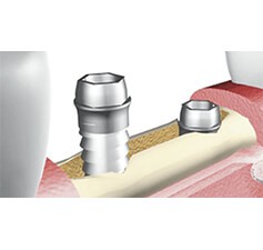 L implantologia senza aumentazione ossea La tecnica dello split crest è una procedura affidabile e l unica che consente di ottenere un incremento orizzontale significativo di circa 5 mm della cresta