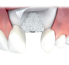 Aumentazione ossea Nell'ambito della chirurgia orale, la procedura di aumentazione ossea ha come obiettivo quello di ripristinare il volume originario perso in seguito alla perdita o all'estrazione
