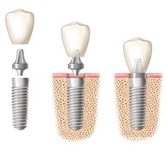 Implantologia L impianto consiste in una vite di titanio (materiale biocompatibile con la struttura ossea, e quindi senza problemi di rigetto) che va a sostituire la naturale radice del dente, sulla