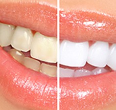 Sbiancamento dei denti Lo sbiancamento dei denti rappresenta uno degli interventi estetici più frequenti, con il quale si persegue il fine di ottenere una dentatura bianca e brillante, che fa da buon