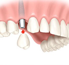 Corona su impianto La corona su impianto rappresenta la soluzione estetica e funzionale più idonea per la mancanza di un dente.