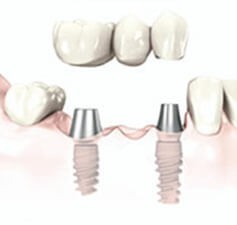 Ponte dentale su impianti Il vantaggio principale di un ponte dentale su impianti, consiste nel lasciare integri quei denti sani sui quali tradizionalmente veniva ancorato il ponte.