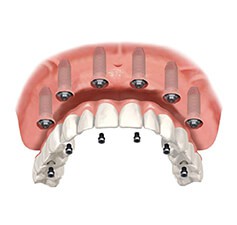 All-on-6 Il metodo All-on-6 risolve il problema dell edentulia totale, sostituendo i denti mancanti nell'arcata superiore o inferiore mediante un ponte dentale avvitato ad arcata completa supportato