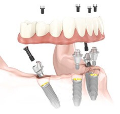 All-on-4 La tecnica denominata All-on-4: un sistema tecnologicamente avanzato, in grado di restituire i denti a chi li aveva perduti, avvitando un ponte dentale su quattro impianti, che fungono da