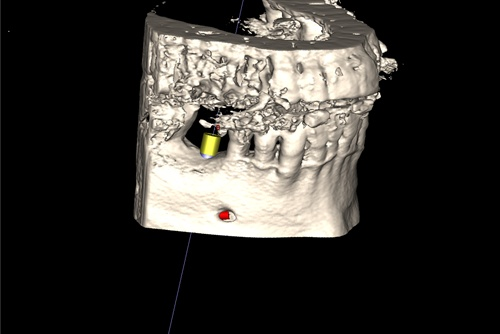 Di seguito una sequenza di immagini per mostrarvi la sostituzione di un molare mandibolare tramite implantologia.