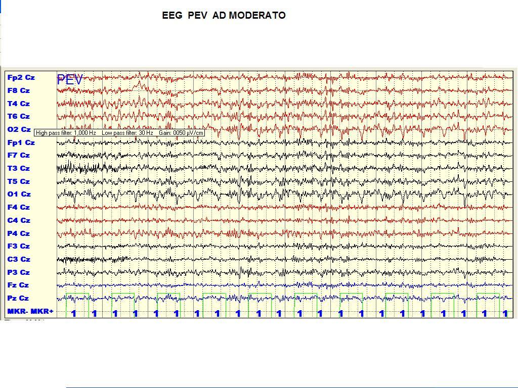 Potenziali evocati(visivi e uditivi e evento correlati SI REGISTRA UN EEG STIMOLANDO IL