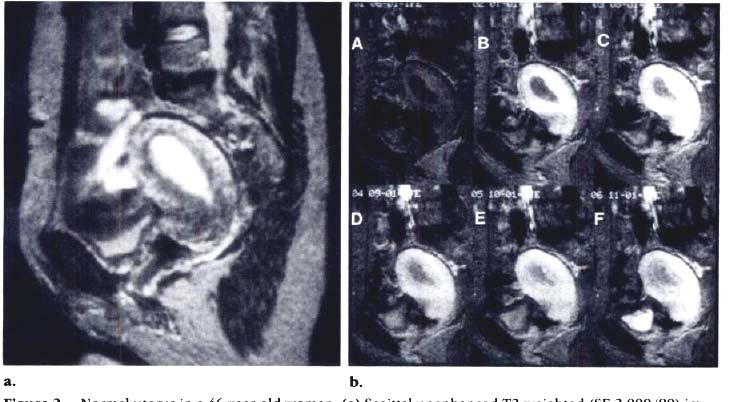 Esempio 2 Utero normale in una donna di 46 anni. a) immagine sagittale pesata in T 2 senza m.d.c.(se 2000/80).