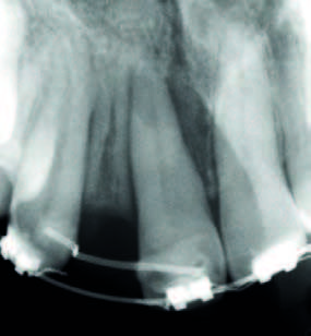 Fig. 2 Fig. 3 Fig. 4 Fig. 5 stata sottoposta a trattamento ortodontico, ma non a riabilitazione protesica. In seguito alla valutazione della situazione clinica e dell esame RX ortopantomografico (Fig.