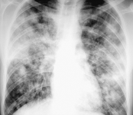 68 anni, Polmonite da Aspergillus