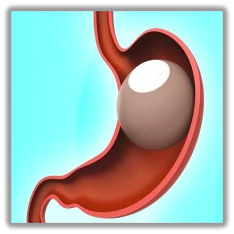 Palloncino intragastrico Il palloncino intragastrico (BIB) è un dispositivo temporaneo in materiale biocompatibile che viene posizionato per via endoscopica nello stomaco che determina un parziale
