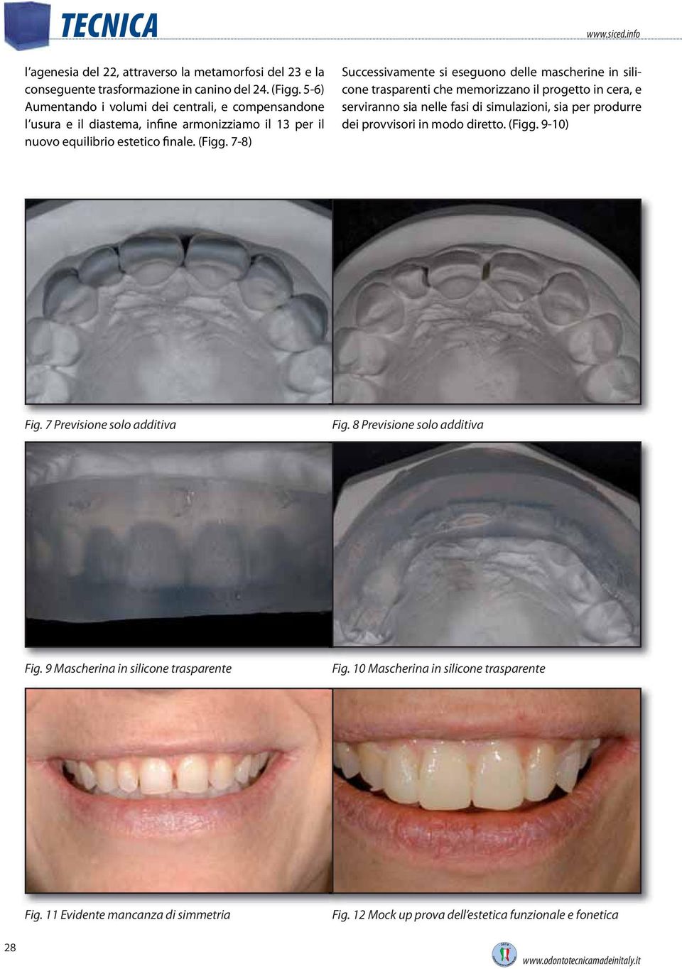 7-8) Successivamente si eseguono delle mascherine in silicone trasparenti che memorizzano il progetto in cera, e serviranno sia nelle fasi di simulazioni, sia per produrre dei