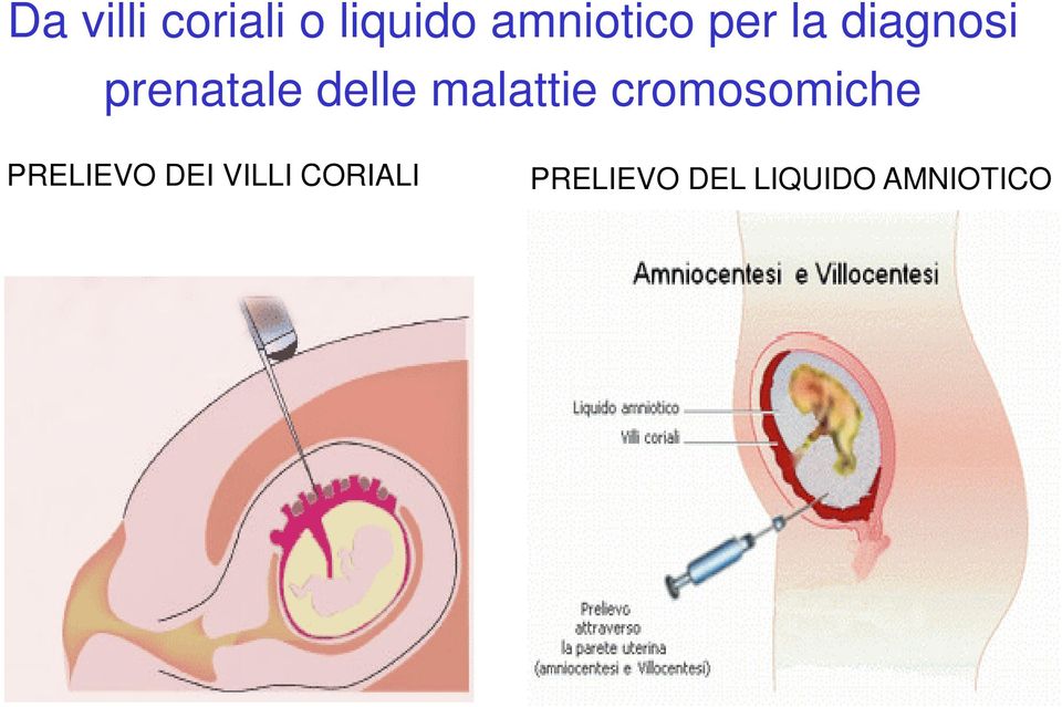 malattie cromosomiche PRELIEVO DEI