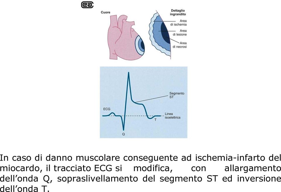 si modifica, con allargamento dell onda Q,