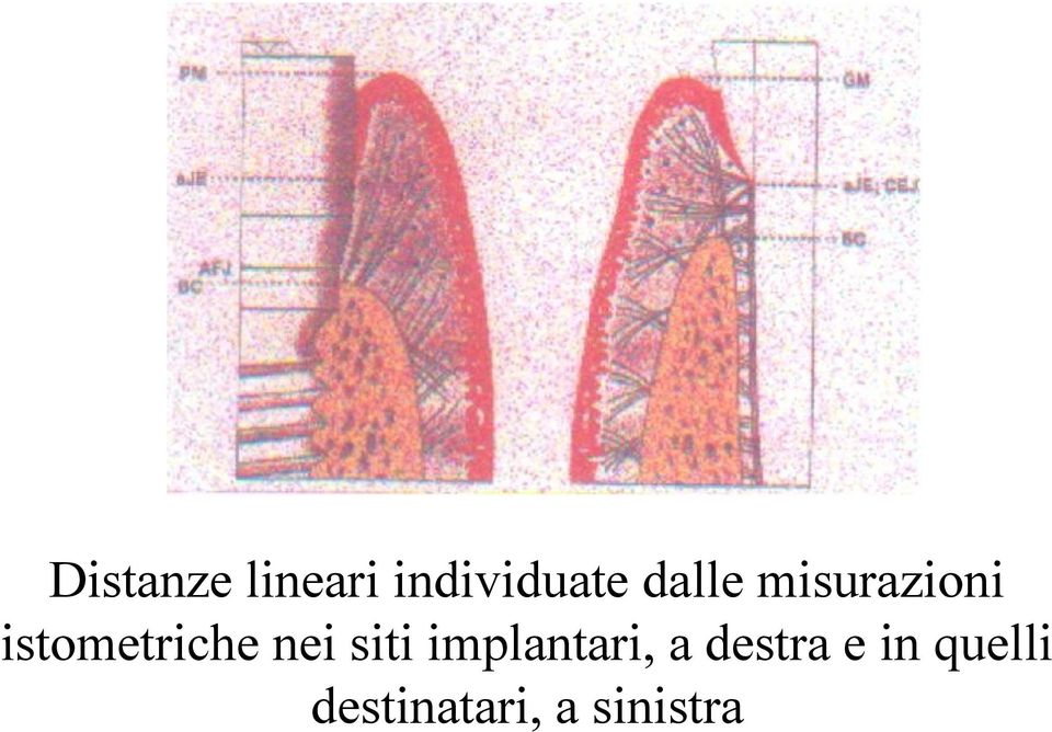 nei siti implantari, a destra e