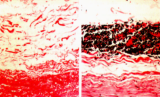 ATEROSCLEROSI AORTICA Infiltrazione della