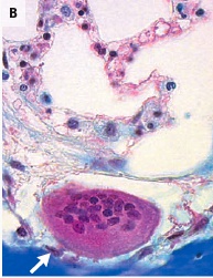 Denosumab e bisfosfonati: diverso meccanismo d azione sugli osteoclasti RANKL RANK OPG Denosumab Denosumab inibisce il RANKL Precursori degli osteoclasti BP = bisfosfonati
