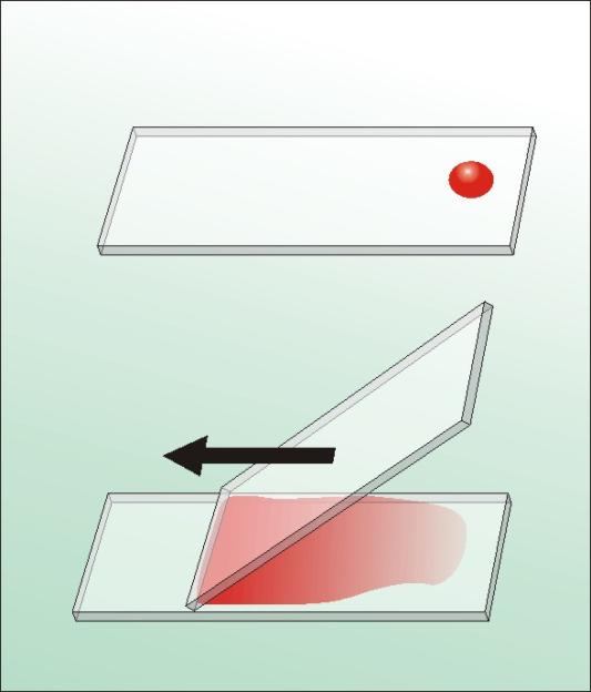 lo striscio di sangue Lo striscio,, una delle tecniche istologiche più diffuse, consente lo studio microscopico delle
