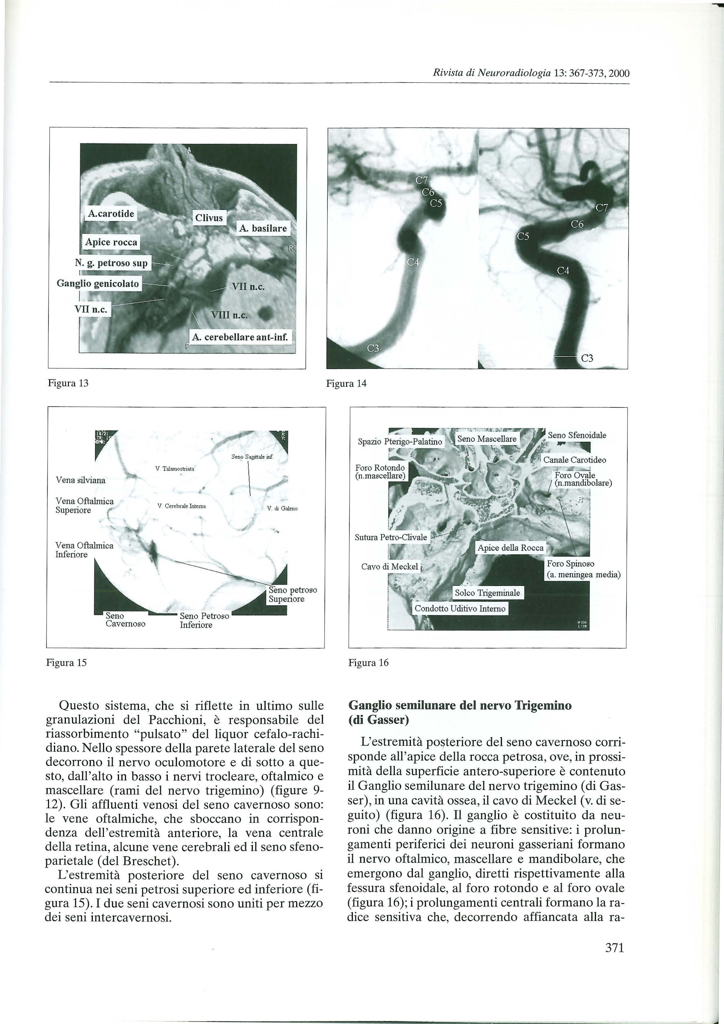 Rivista di Neuroradiologia 13: 367-373, 2000 Ga Figura 13 Figura 14 Vena silviana Vena Oftalrnica Supe1iore ' ( V Talamostriata. V Cerebrale lnttma V.