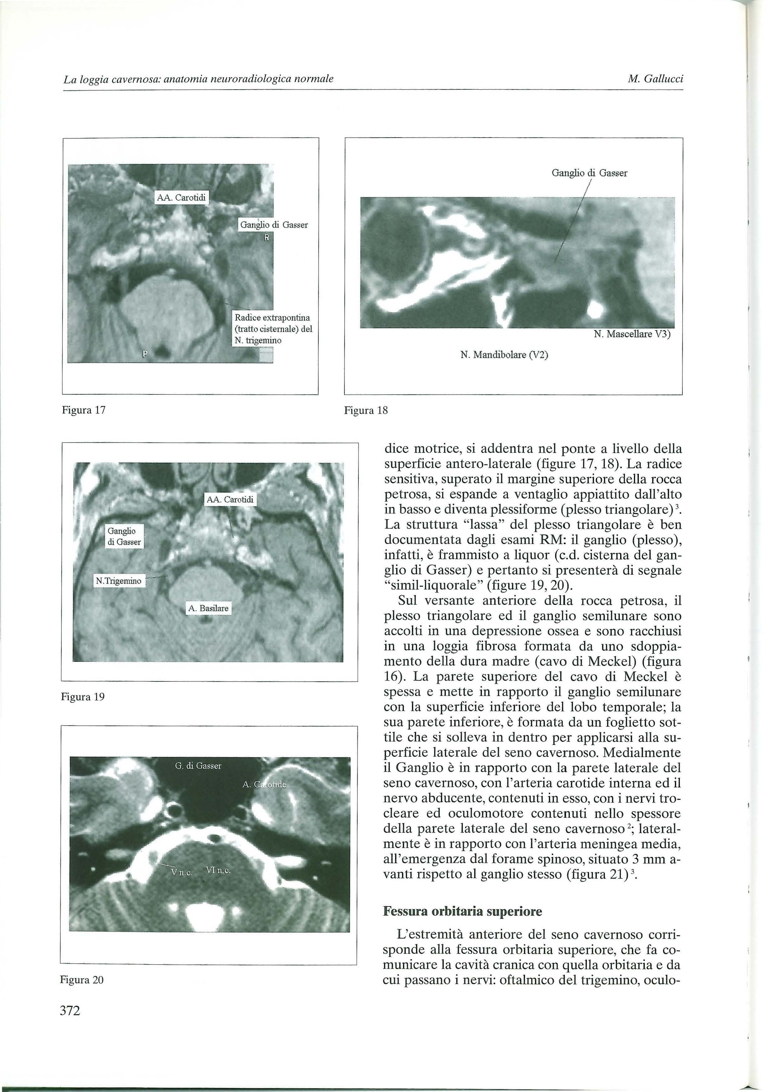 La loggia cavernosa: anatomia neuroradiologica normale M. Gallucci Ganglio cli Gasser N.