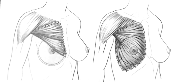 che serve a ridurre l effetto scalino sulla parte superiore della mammella, dovuto al deficit del muscolo grande pettorale.