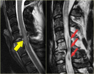 RMN vantaggi diretta visualizzazione del midollo spinale EDEMA vs EMORRAGIA >risoluzione di contrasto,