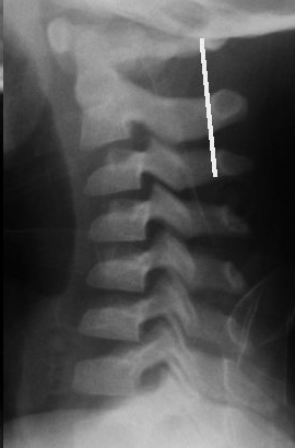 PSEUDOLUSSAZIONE Swischuk s line fisiologico disallineamento riscontrabile nei