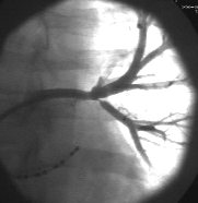 COMPLICANZE (1) STENOSI/OCCLUSIONE DELLE VP ( 2%) Presentazione clinica: tosse, dispnea, dolore pleuritico, emottisi.