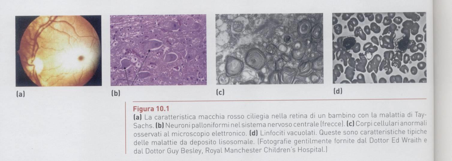 Malattia di Tay-Sachs Malattia da accumulo di gangliosidi nei lisosomi neuronali dovuta a difetto di esosaminidasi A.