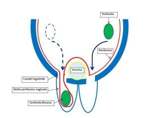 Criptorchidismo E' la piu comune anomalia del sistema uro-genitale Il bambino non si lamenta ed è solo l'esame obiettivo o l osservazione del genitore a rivelare l assenza del testicolo dallo scroto.