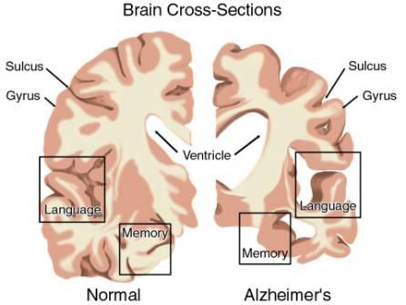 Malattie Neurodegenerative PD