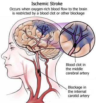 Stroke Controllo Fattori di Rischio