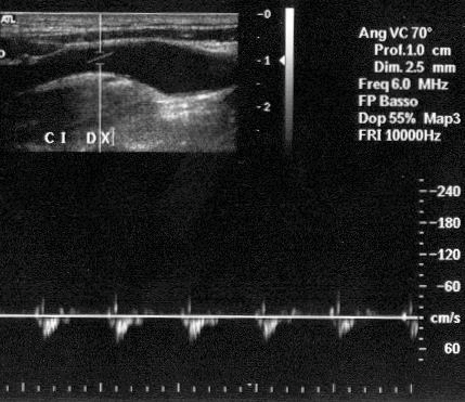 1) Quantificazione emodinamica del grado di stenosi mediante il doppler pulsato con correzione dell angolo d incidenza Diversa influenza dell errore di stima dell angolo sull accuratezza della misura