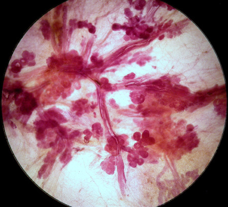 GIORNO 2 8:30 Eterogeneità del carcinoma in situ, cont. - L. Tabár, T. Tot Classificazione dei sottotipi di carcinoma in situ, basati sull aspetto radiologico. Parte II.